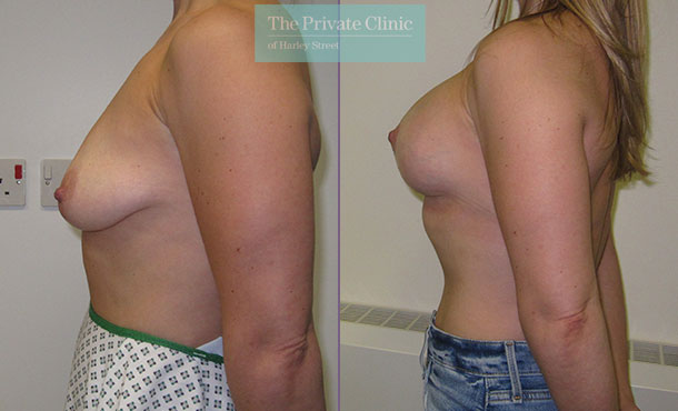 Breast Uplift with Implants - 001MF-Side2