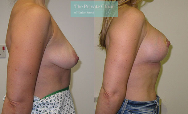 Breast Uplift with Implants - 001MF-Side