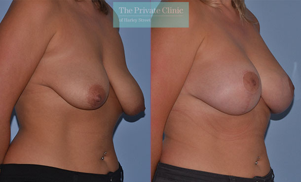 Breast Asymmetry - 018AR-Side
