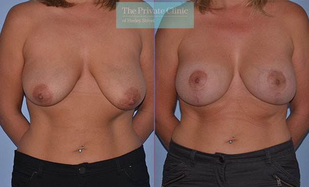 breast uplift mastopexy surgery before after results photos mr adrian richards front 018AR