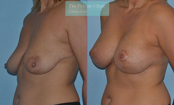 Breast Uplift with Implants - 025AR-Side