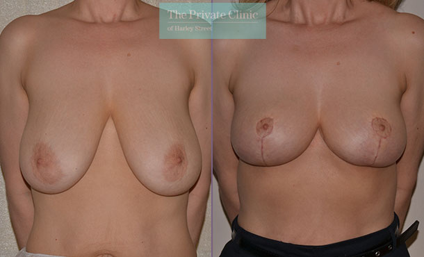 Breast Uplift - 020AR-Front