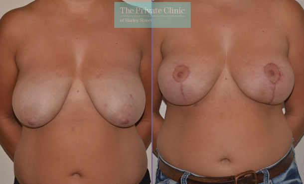 breast uplift surgery before after photos uk mr adrian richards front 017AR