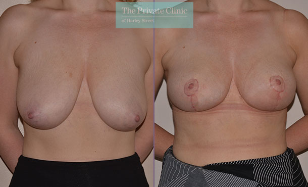 breast uplift surgery before after photos uk mr adrian richards front 024AR