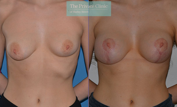 correct breast asymmetry surgery before after results front Adrian Richards 047AR