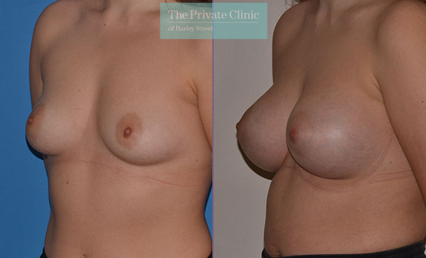 Breast Asymmetry - 054AR-Side