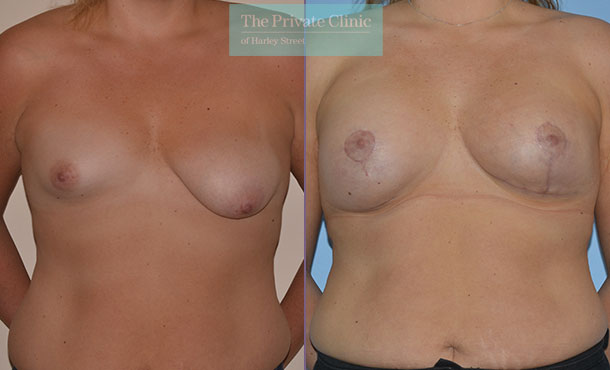 correcting breast asymmetry before after results front Adrian Richards 053AR