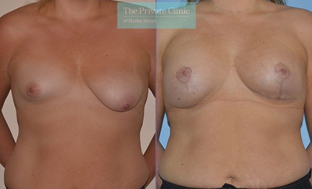 Breast Asymmetry - 053AR-Front