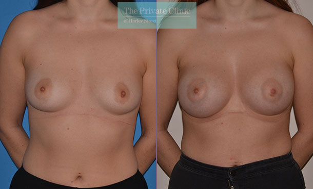 Breast Asymmetry - 054AR-Front