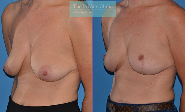 dropping breasts uplift mastopexy before after photo uk mr adrian richards angle 021AR