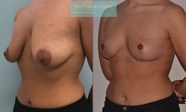 dropping breasts uplift mastopexy before after photos mr adrian richards angle 026AR