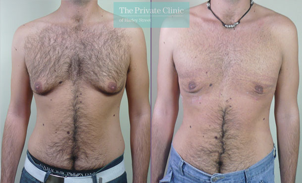 Male Chest Reduction - Gynecomastia Surgery, Men Boobs Lipo London