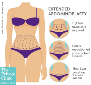 extended tummy tuck scars abdominoplasty