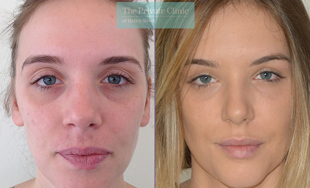 face fat transfer london facial rejuvenation lipofilling before after photos results mr roberto uccellini 005RU