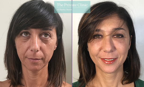 Face Fat Transfer Under eye and cheeks