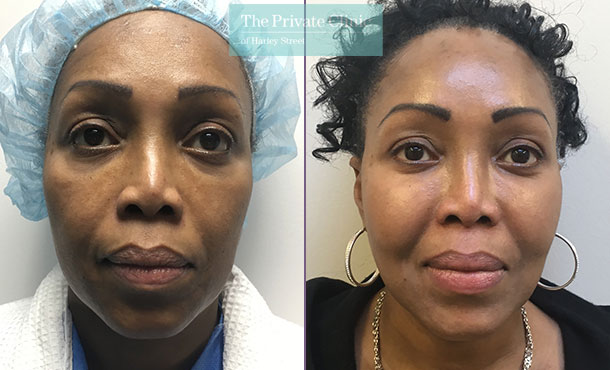 fat transfer face inejctions facial rejuvenation lipofilling before after results photos mr roberto uccellini front 002RU