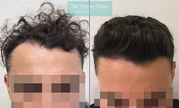 fue hair transplant follicular unit extraction before after results mr michael mouzakis 018MM