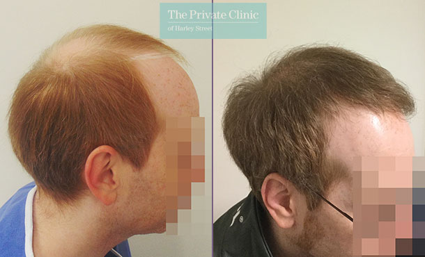 fue hair transplant uk before after photo results mr michael mouzakis side 002MM