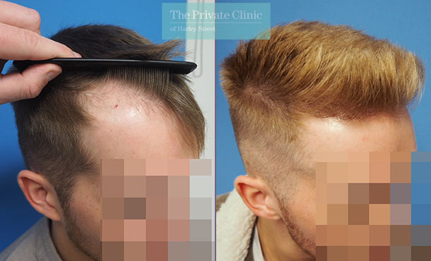 fue hair transplantation before after photo results mr michael mouzakis side 016MM