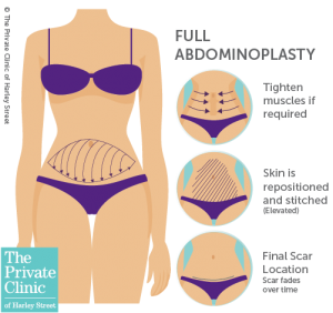 full tummy tuck surgery abdominoplasty procedure scars