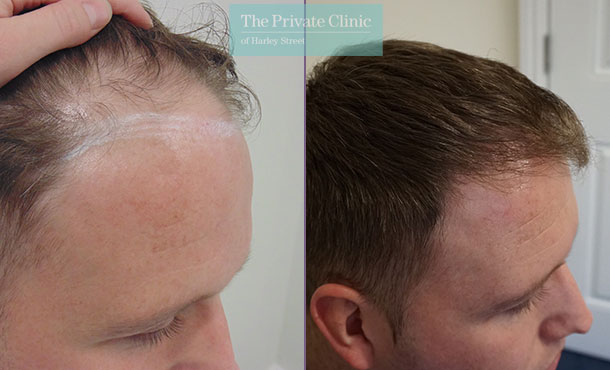 FUE Hair Transplant - 004MM