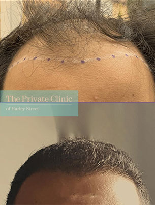 hair transplant before after photos fue results leeds dr furqan raja 001FR