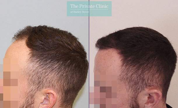 hair transplant before after results mr michael mouzakis side 021MM