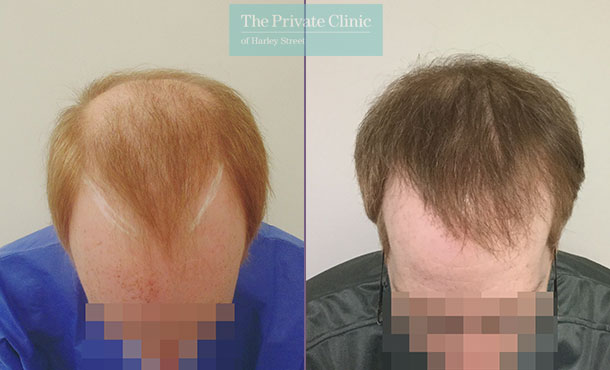 FUE Hair Transplant - 002MM-Front