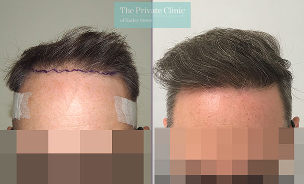 FUE Hair Transplant - 014MM-Front