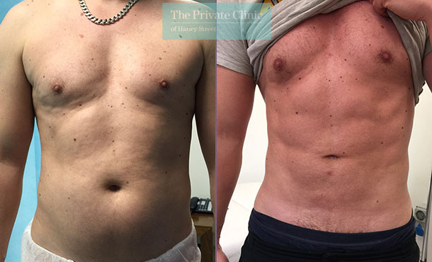 high def vaser liposuction lipo male before after results photos uk the private clinic 002TPC