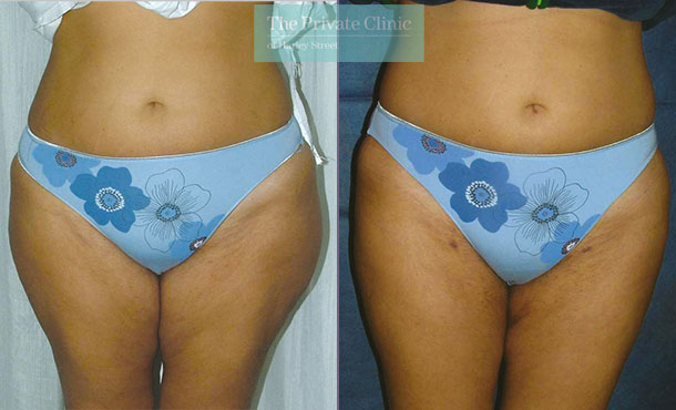 inner thighs liposuction vaser lipo before after results photos the private clinic 010TPC