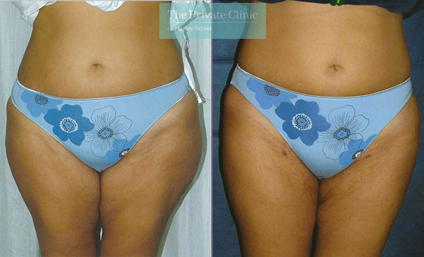 Vaser Liposuction - 010TPC