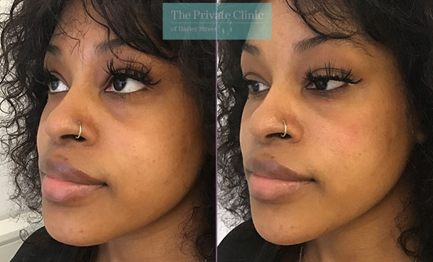 jaw chin fillers before after photos uk results the private clinic 007TPC