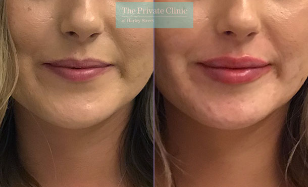 lip fillers injection before after photos london dr hanson front 001HHY