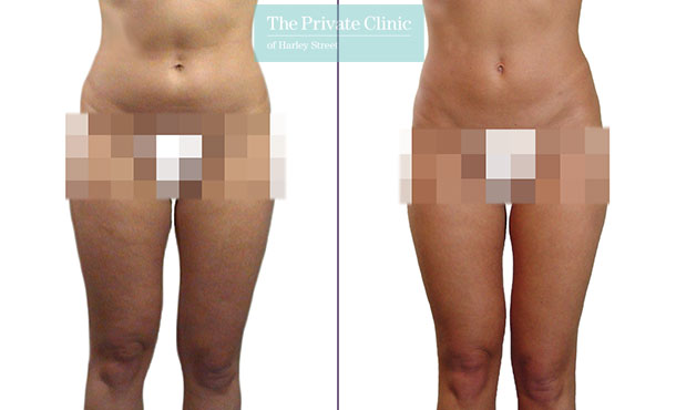 Liposuction - 016RU-Front