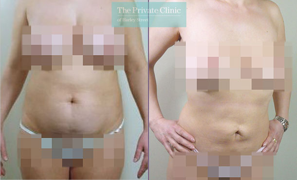 lipo lipoplasty stomach liposuction traditional surgical before after photos results mr roberto uccellini front 026RU