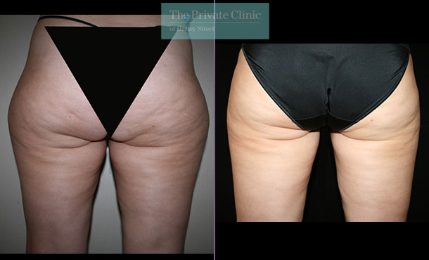 liposuction thighs inner outer vaser lipo before after photos results dr dennis wolf 013DW