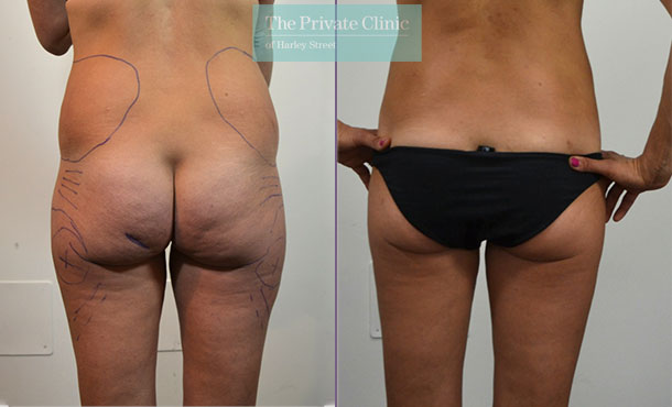 liposuction traditional surgical lipo lipoplasty before after photos uk results mr roberto uccellini front 017RU