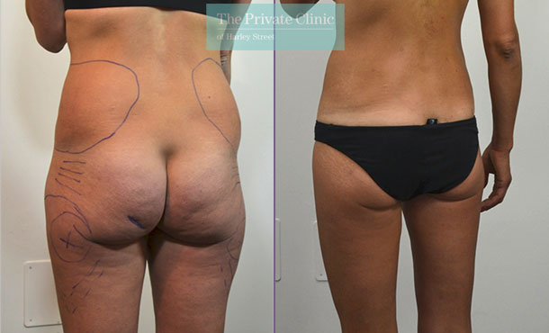 Liposuction Flanks, Hips, Outer Thighs