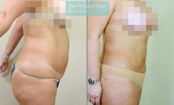 liposuction tummy traditional surgical lipo lipoplasty before after results photos mr roberto uccellini side 022RU