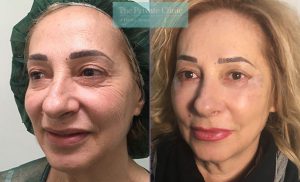 lower blepharoplasty eyelid surgery eyebag fat transfer mr roberto uccellini before after results photos angle 003RU