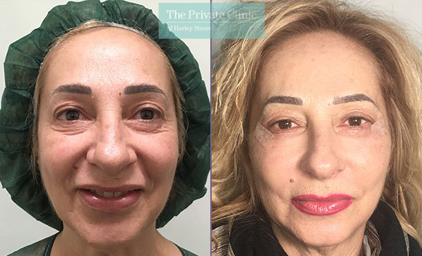 lower blepharoplasty eyelid surgery eyebag fat transfer mr roberto uccellini before after results photos front 003RU