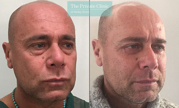 lower blepharoplasty male eyelid surgery eyebag fat transfer mr roberto uccellini before after results photos 004RU