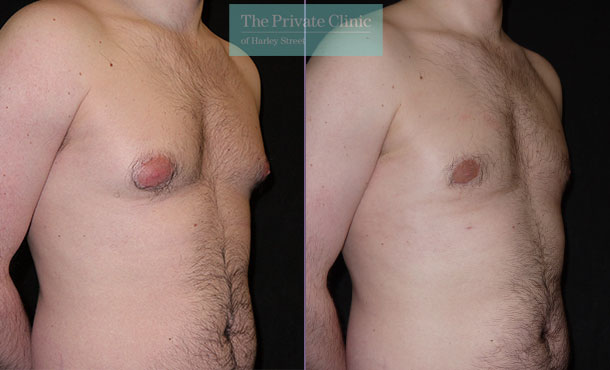 Post Op Surgery Gynecomastia Lipo Slim