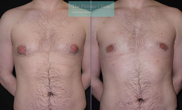 Male Chest Reduction - 001TPC-Side - The Private Clinic of Harley