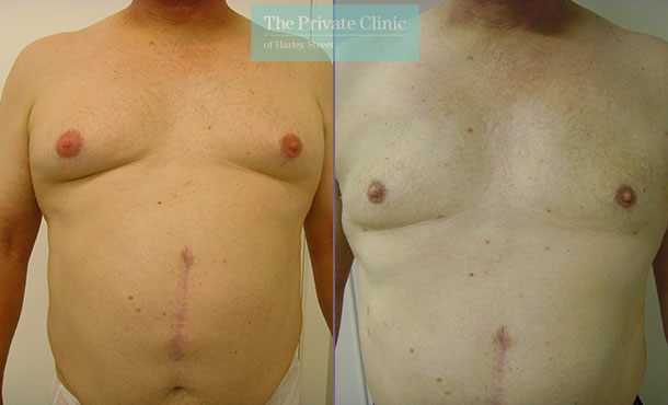 male chest reduction gynecomastia surgery micro lipo before after photos results front 001TPC