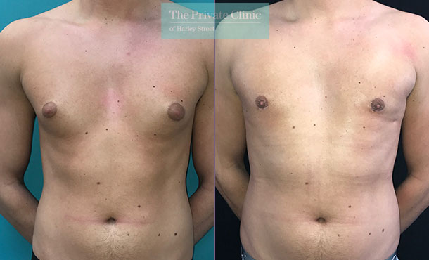 male chest reduction liposuction gynecomastia surgery before after photos london results front 003MB