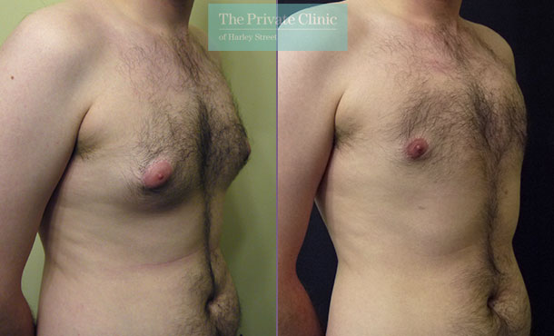 male chest reduction surgery uk liposuction gynecomastia before after photos results angle 001MB