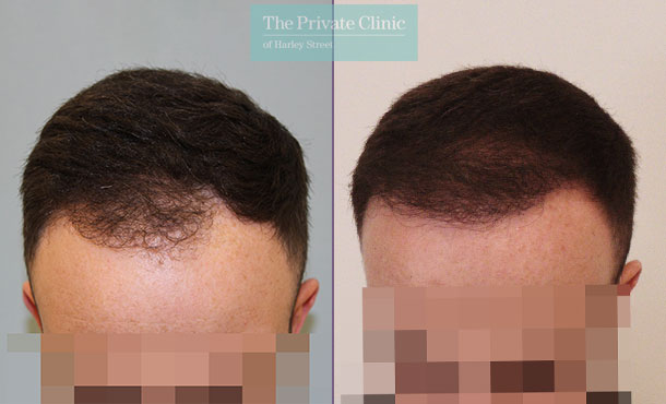 FUE Hair Transplant - 021MM