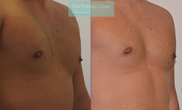 male nipple reduction before after photos results mr adrian richards 037AR